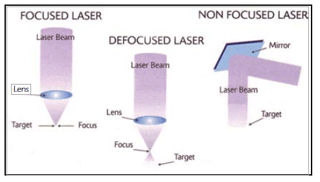 SURGICAL LASER LENS FOCUSING.png