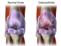 knee osteoarthritis.jpeg